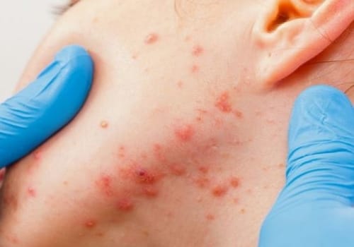 Skin Condition
