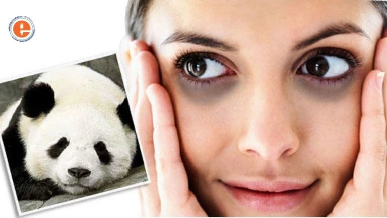 Home Remedies Will Help you Get Rid Of Annoying Dark Circles